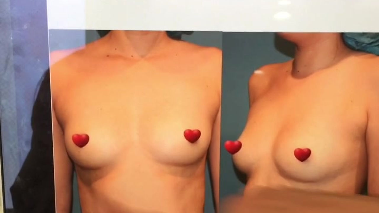 Breast Video Gallery